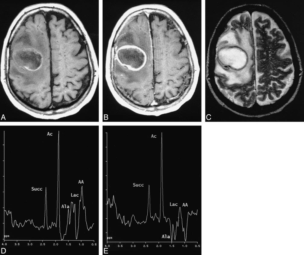 AJNR: 20, June/July 1999 BRAIN ABSCESS 1051 FIG 2. MR images of patient 2 with a brain abscess.