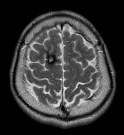 Lesional neocortical epilepsy Discrete