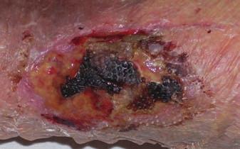 developed. Larval therapy and surgical debridement were used to clear the area and systemic antibiotics were used. Negative pressure wound therapy was delivered with the V.A.C.
