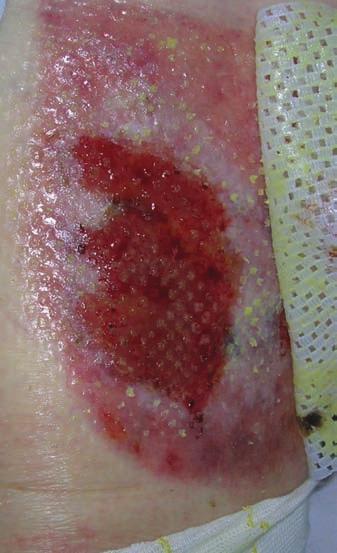 The wound at final assessment (day 11); the hypergranulation has resolved and the wound is ready to progress. health with no evidence of skin stripping or trauma.