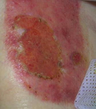 After eight days and eight dressing changes the hypergranulation had resolved and the periwound area remained intact (Figure 13). The patient had not found the dressing changes painful.