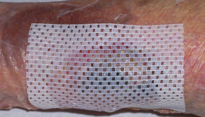 This wound had been dressed with Mepilex (Mölnlycke Healthcare) and Allevyn (Smith and Nephew) borderless dressings secured with orthopaedic bandages and yellow line Comfifast tubular bandage