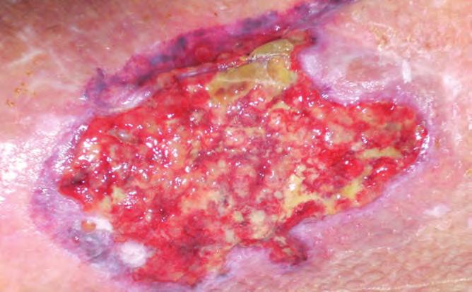 CASE REPORT 6 cont. 5% epithelial tissue. There was still a small plug of slough at the top of this wound (Figure 3).