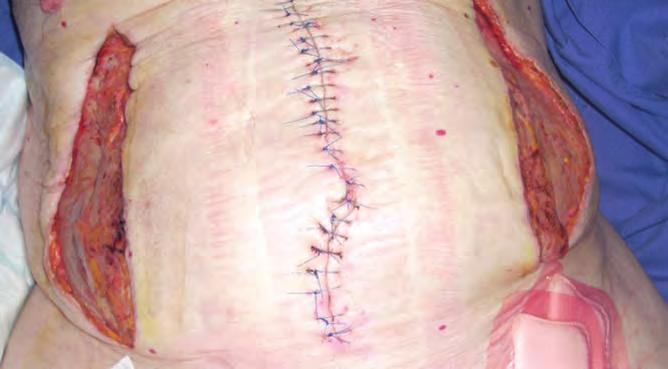 CASE REPORT 9 This case report features an 80-yearold man who had undergone major abdominal surgery using a mesh repair and the formation of two fasciotomies (Figures 1, 2 and 3).