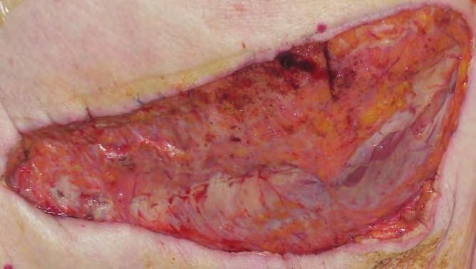 Exudate from both of the wounds was observed to be low in both volume and viscosity. The wound beds were again covered with Silflex with an absorbent pad used as a secondary dressing.