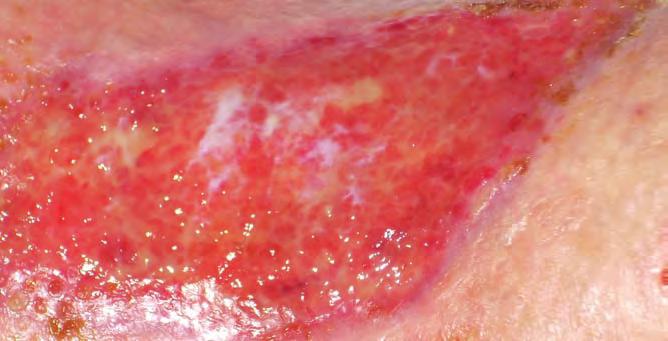 After four weeks (Figure 1), the wound remained open and after treatment with a honey tulle dressing the clinical team decided that it would benefit from a skin replacement.