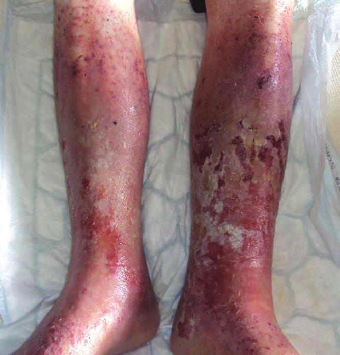 CASE REPORT 12 This case features an 88-year-old man who presented with varicose eczema on his lower limbs secondary to underlying venous disease and cardiac oedema.
