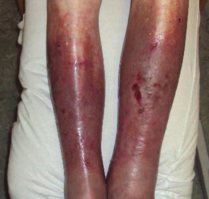 First review As can be seen in Figure 1, the eczema is widespread with various wounds and vulnerable areas of skin.