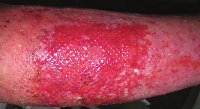 CASE REPORT 13 This case report features an 85-yearold man who presented with general varicose eczema and a large superficial area of exposed dermis on the outer aspect of his right calf.