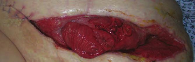 CASE REPORT 14 This case report features a 54-year-old woman with a dehisced abdominal post surgical wound.