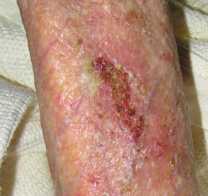 CASE REPORT 2 cont. Review 3 The wound was reviewed a week later and presented as a dry wound with buds of granulation tissue and epithelialisation occurring at the edges (Figure 3).