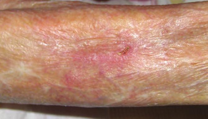 Review 4 A week later the wound had completely epithelialised, leaving healthy intact skin (Figure 4).