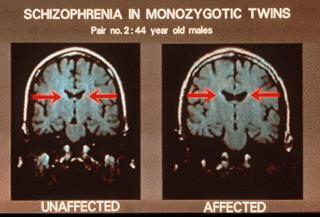 Enlarged Ventricles in the Brain: Individuals with schizophrenia, including those who have never been