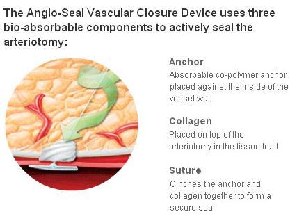 Closure Devices Angio-Seal Evolution Vascular Closure Device Allows a quick and effective seal of the femoral artery during minimally invasive catheterbased procedures Hemostasis achieved through