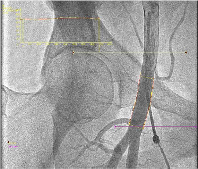 IDEAL STICK LEVEL 33 FEMORAL ACCESS SITE COMPLICATIONS EVALUATED FOR PUNCTURE LOCATION ANGIOGRAPHICALLY