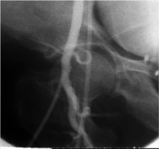 EPIGASTRIC ARTERY Inferior epigastric artery ANGIOGRAPHIC PREDICTORS OF FEMORAL ACCESS SITE COMPLICATIONS: