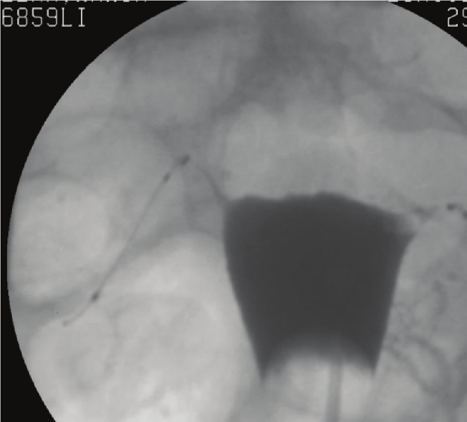 2 CaseReportsinObstetricsandGynecology Figure 1: Post-Essure hysterosalpingogram (HSG) (12/29/11): no spillage is noted on either side, which confirms bilateral tubal occlusion, while showing the