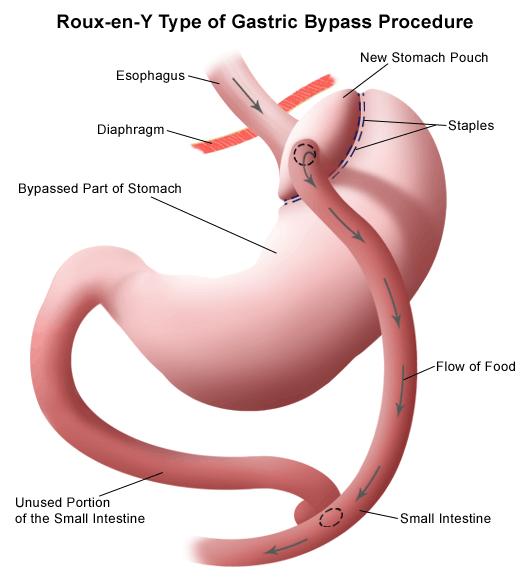 Bariatric Procedures The main bariatric procedures that are carried out in ARI are the Gastric Bypass and the Sleeve Gastrectomy. Both of these procedures are carried out by keyhole surgery.