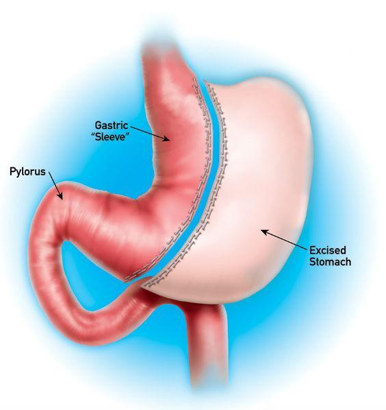Sleeve Gastrectomy The Sleeve Gastrectomy also works by making your stomach smaller. A large part of your stomach is removed, leaving a column shaped stomach (about the size of a banana).