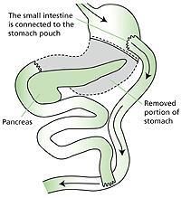 Gastric Bypass- Definition By Mayo Clinic staff Weight-loss (bariatric) surgeries change your digestive system, often limiting the amount of food you can eat.