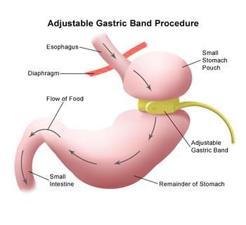Many surgeons prefer gastric bypass surgery because it generally has fewer complications than other weight-loss surgeries.