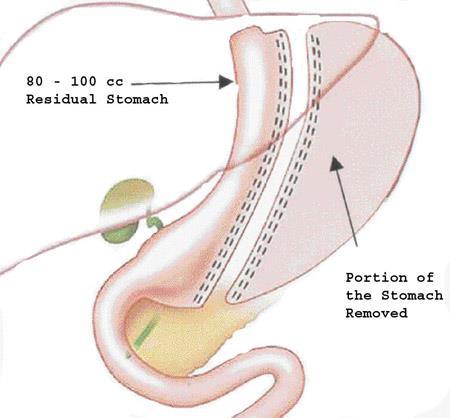 Vertical banded gastroplasty. This operation, also referred to as stomach stapling, divides the stomach into two parts limiting space for food and forcing you to eat less. There is no bypass.