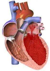 Mitral Valve Regurgitation Normal Heart Diseased Heart Mitral Regurgitation