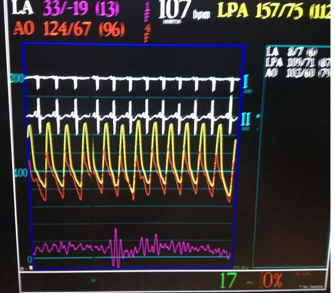 Figure 2: Pulmonary arterial pressure waveform (yellow) superimposed on systemic pressure