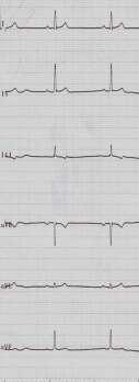 SQTS: 17 years-old boy with history of syncope Short QTc interval: 283ms ERS Brugada like pattern