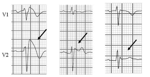 Brugada Syndrome BrS is a primary electrical disease characterized by complete or incomplete RBBB and ST-segment elevation in leads V1 through V3 on surface electrocardiogram (ECG).