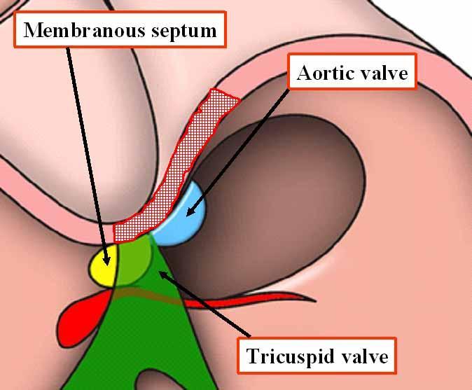 Perimembranous defects complications Complete atrioventricular block (cavb) Early or late