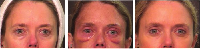 6 months) 3 1 Er:YAG 6 0 1 / 2 12 months 1 0 Total 18 16 7 / 2 12 (4.3 months) 4 1 n Two patients had concomitant temple lift. w Three patients had concomitant brow-lift.