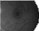 Disclosures From Print to Practice: PVD a common process with potential for ocular