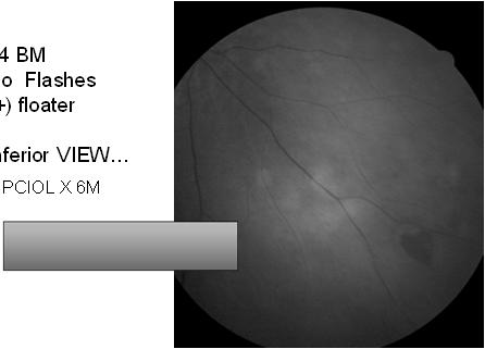 Lattice degeneration (LD) vs LD with holes 4. Symptomatic retinal break 5.
