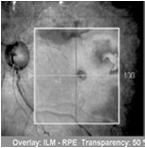 OCT criteria (2006) Lamellar macular hole