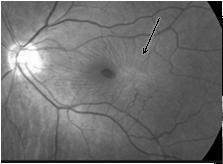 FTMH Break in inner retinal layer