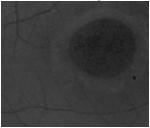 20/80-20/200 IV: Macular hole + complete