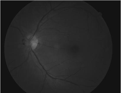 Pigment on the retina CC: F/F OS X 3days BCVA: 20/20 OD SLE Cataracts OS>OD + PVD OS 56 WM 20/25 OS Anterior vitreous DFE: NO RB or RRD are found Based on what