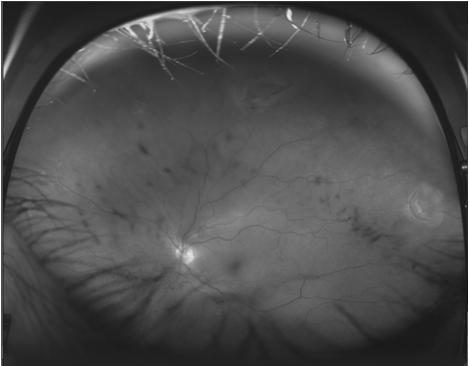 The truth about VH associated with a retinal break CC: