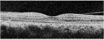 traumatic macular hole PMHx: HTN & DM BCVA: 20/25 OD, 20/400 OS OD Which one are you more