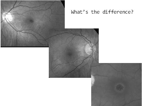round, circumscribed reddish lesion located over the fovea. What s the difference?