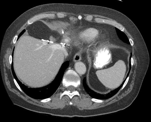 Extended Left Hepatectomy for IHCC Infiltrating moderately differentiated adenocarcinoma, most