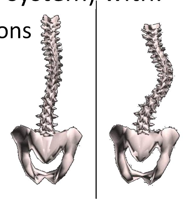 A Chaotic Scoliosis is a real 3D structural scoliosis (dynamic deterministic system) with: Highly