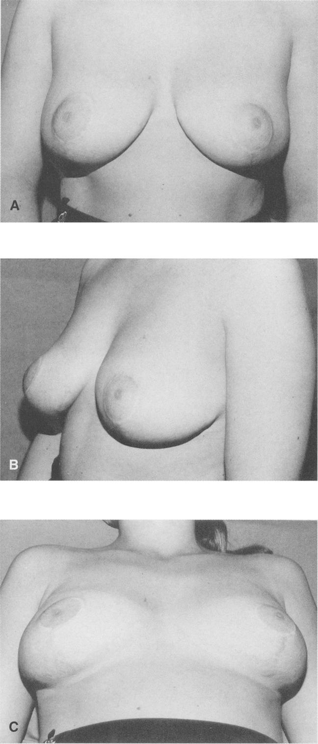 46 2.73 Figure 1 (A,B,C) Frontal, left oblique and recumbent views of inferior mound reduction: the views used by the surgeons to assess the results.