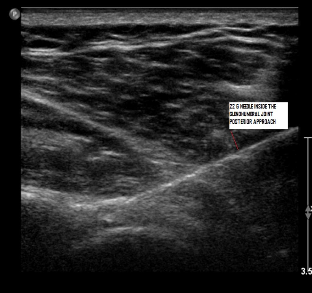 Fig. 5: 22G spinal needle inserted under US
