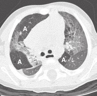 However, when the first CT examination is requested, the differential diagnosis probably includes causes of childhood ILD in addition to neuroendocrine cell hyperplasia of infancy.