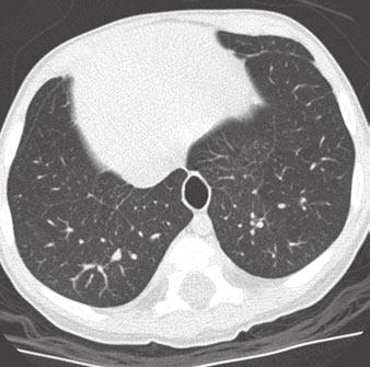 A high-resolution protocol with both inspiratory and expiratory imaging would facilitate evaluation of the lung parenchyma.