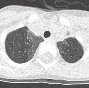 CT of Neuroendocrine Cell Hyperplasia of Infancy biopsy as a definitive diagnostic test in the evaluation of this disorder.