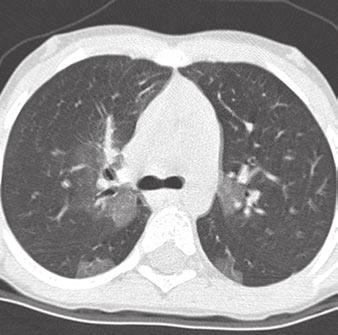 A C, Inspiratory high-resolution CT scans show sharply defined areas of ground-glass opacification along mediastinal borders, peripherally, and most prominently in right middle lobe and lingula