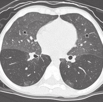 D F, Expiratory high-resolution CT scans show only mild increase in attenuation in all areas of lung, consistent with air trapping involving both areas with ground-glass opacification and areas with